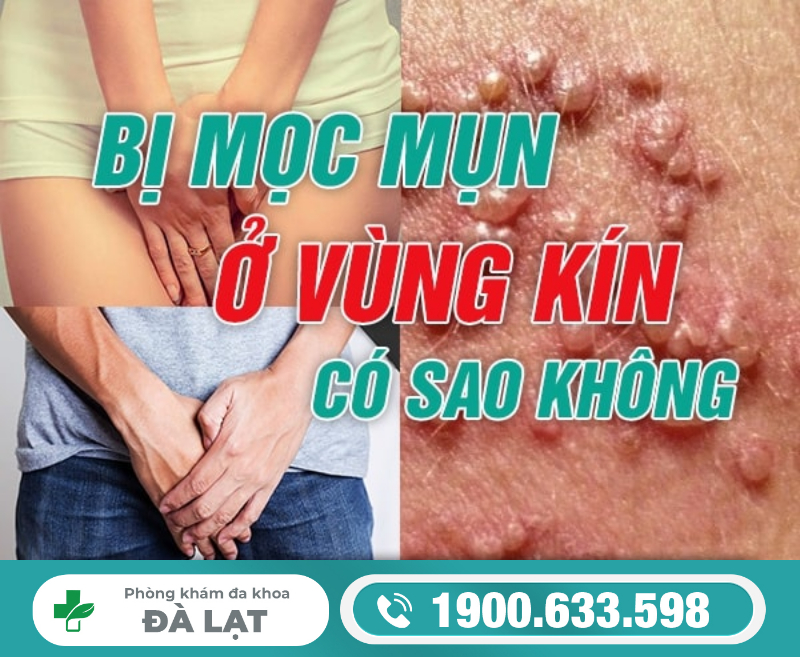 BỊ MỌC MỤN Ở VÙNG KÍN CÓ SAO KHÔNG?